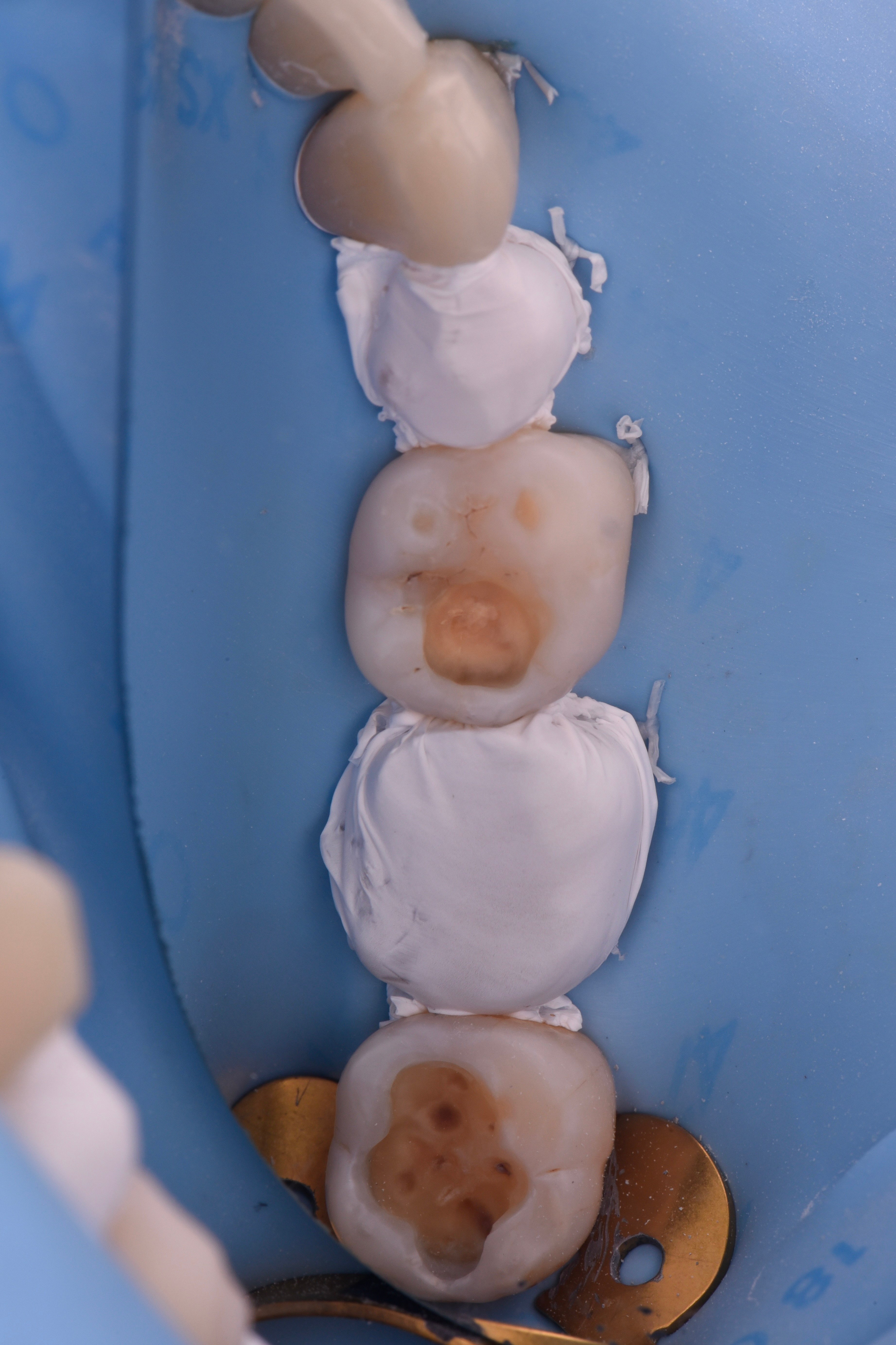 14-ST